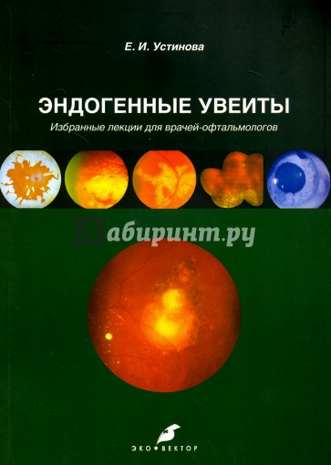 Эндогенные увеиты