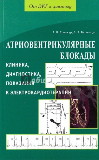 Атриовентрикулярные блокады. Клиника, диагностика, показания к электрокардиотерапии