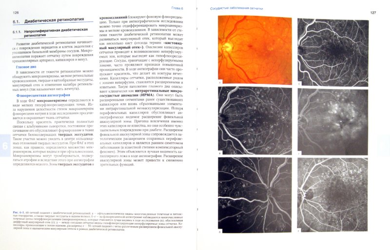 Иллюстрация 1 из 5 для Флюоресцентная ангиография в офтальмологии. Атлас - Дитмар, Хольц | Лабиринт - книги. Источник: Лабиринт