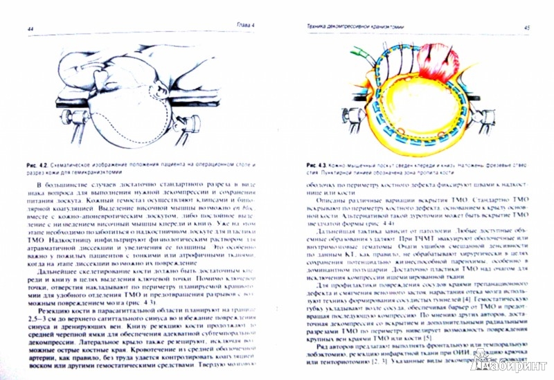 Иллюстрация 1 из 3 для Декомпрессивная краниэктомия при внутричерепной гипертензии | Лабиринт - книги. Источник: Лабиринт
