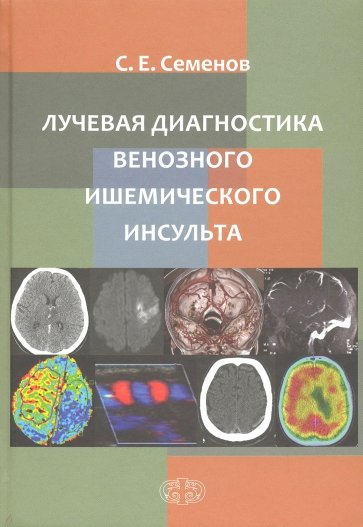 Лучевая диагностика венозного ишемическог инсульта