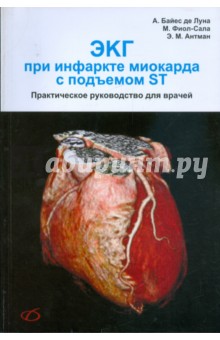 ЭКГ при инфаркте миокарда с подъемом ST - Байдес, Фиол-Сала, Антман