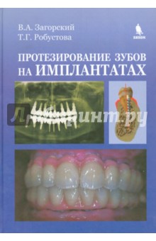 Робустова, Загорский - Протезирование зубов на имплантатах обложка книги Робустова, Загорский - Протезирование зубов на имплантатах обложка книги
