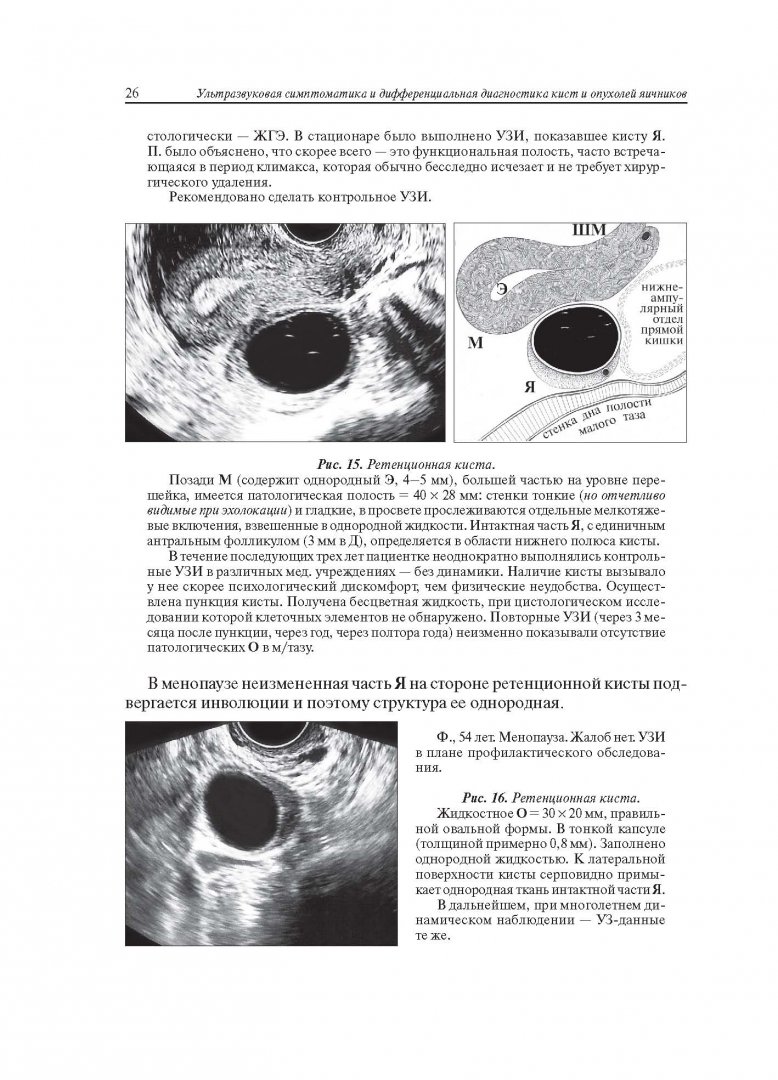 Иллюстрация 15 из 22 для Ультразвуковая симптоматика и дифференциальная диагностика кист и опухолей яичников - Сурен Хачкурузов | Лабиринт - книги. Источник: Лабиринт