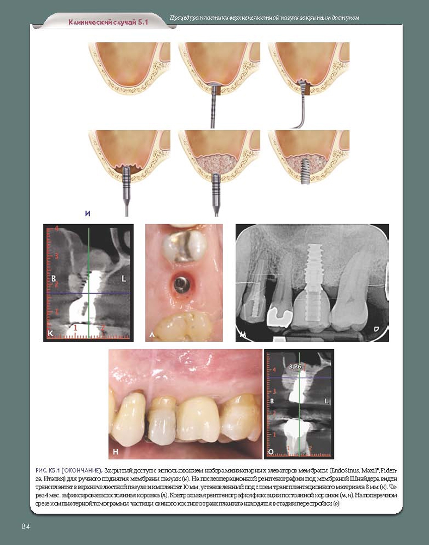 Иллюстрация 6 из 15 для Регенеративные технологии в стоматологии. Научно-практическое руководство - Барон, Нанмарк | Лабиринт - книги. Источник: Лабиринт