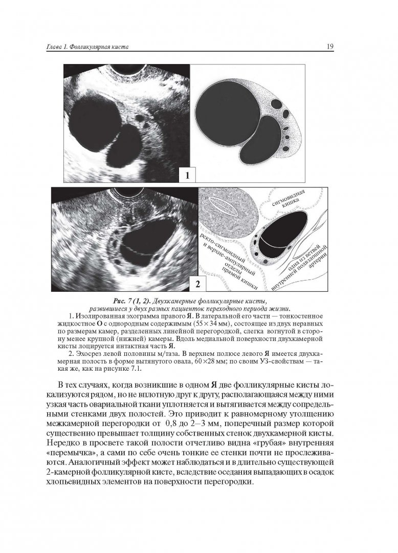 Иллюстрация 8 из 22 для Ультразвуковая симптоматика и дифференциальная диагностика кист и опухолей яичников - Сурен Хачкурузов | Лабиринт - книги. Источник: Лабиринт