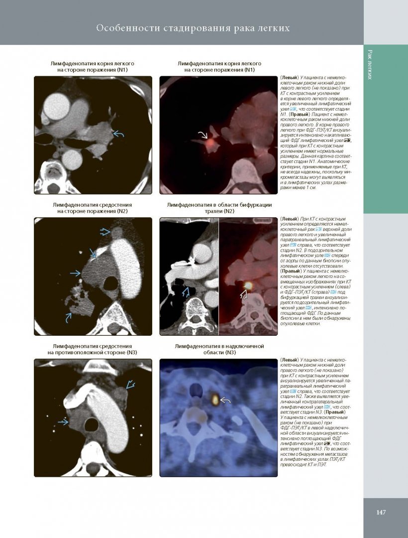 Иллюстрация 2 из 12 для Лучевая диагностика. Опухоли органов грудной клетки - Розадо-де-Кристенсон, Картер | Лабиринт - книги. Источник: Лабиринт