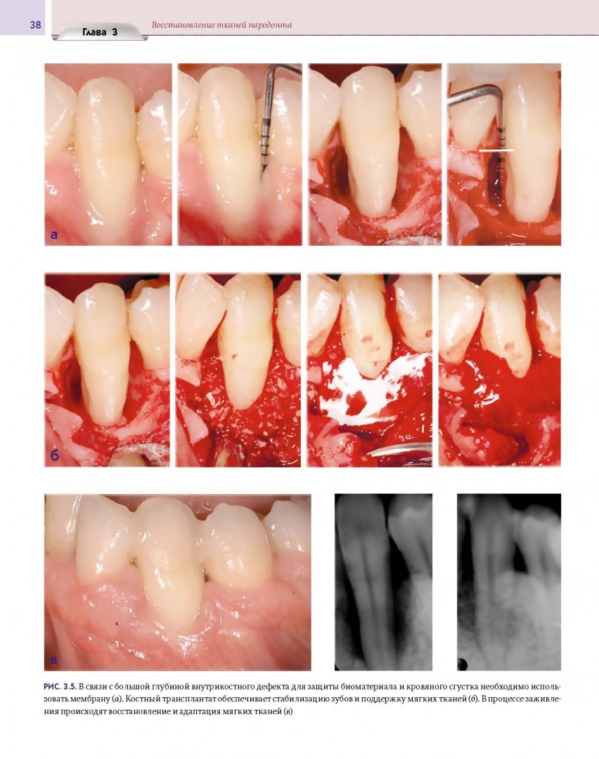 Иллюстрация 15 из 15 для Регенеративные технологии в стоматологии. Научно-практическое руководство - Барон, Нанмарк | Лабиринт - книги. Источник: Лабиринт