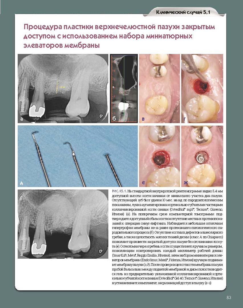 Иллюстрация 5 из 15 для Регенеративные технологии в стоматологии. Научно-практическое руководство - Барон, Нанмарк | Лабиринт - книги. Источник: Лабиринт