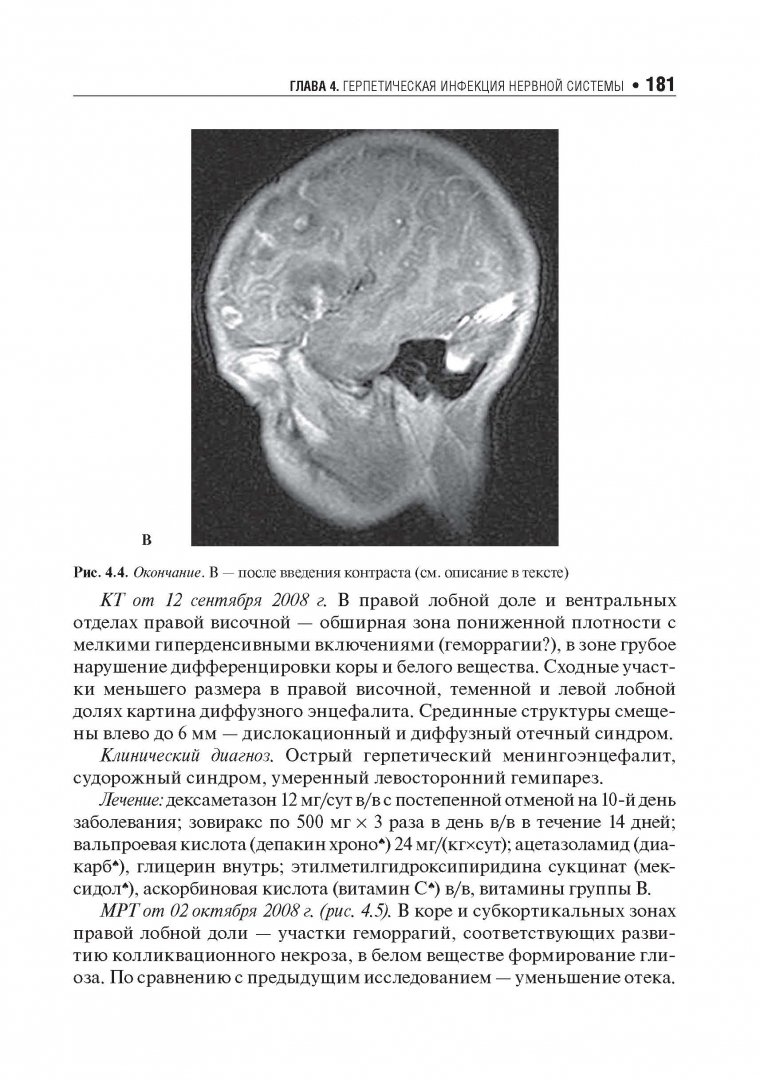 Иллюстрация 9 из 11 для Хронические нейроинфекции. Руководство - Баранова, Бойко, Завалишин, Спирин, Никитин | Лабиринт - книги. Источник: Лабиринт