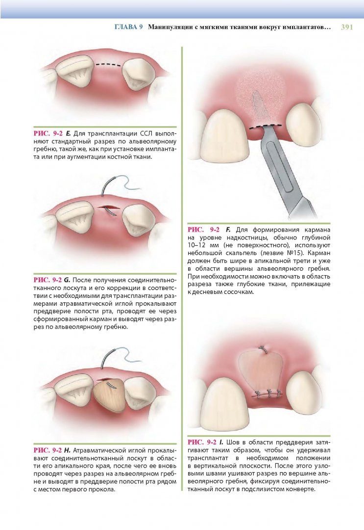 Иллюстрация 18 из 30 для Дентальная имплантология. Хирургические аспекты - Майкл Блок | Лабиринт - книги. Источник: Лабиринт