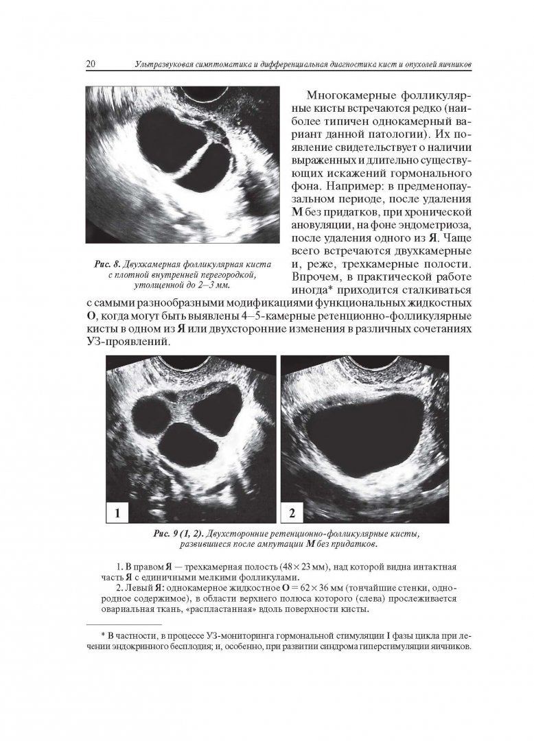Иллюстрация 10 из 22 для Ультразвуковая симптоматика и дифференциальная диагностика кист и опухолей яичников - Сурен Хачкурузов | Лабиринт - книги. Источник: Лабиринт