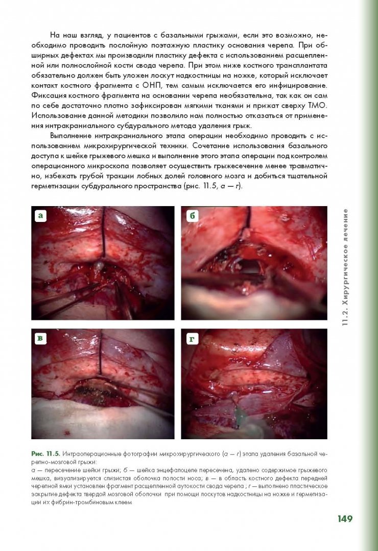 Иллюстрация 17 из 28 для Эндоскопическая диагностика и лечение назальной ликвореи - Потапов, Лопатин, Капитанов | Лабиринт - книги. Источник: Лабиринт