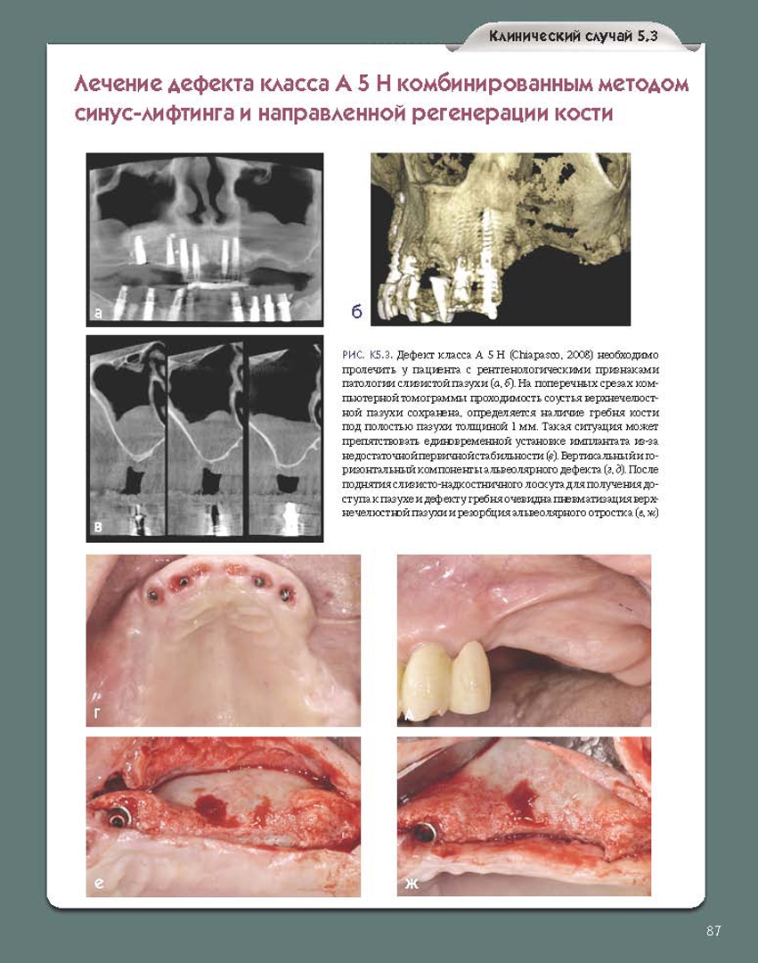 Иллюстрация 7 из 15 для Регенеративные технологии в стоматологии. Научно-практическое руководство - Барон, Нанмарк | Лабиринт - книги. Источник: Лабиринт