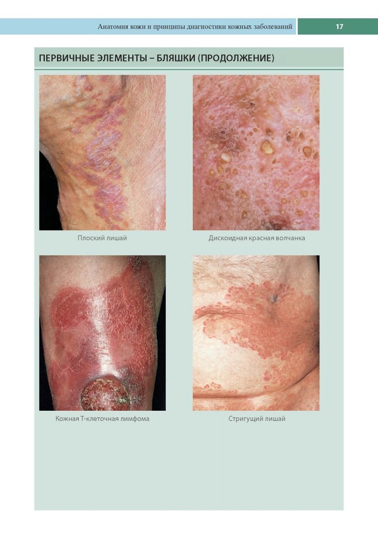 Иллюстрация 7 из 19 для Клиническая дерматология. Акнеподобные и папулосквамозные дерматозы - Томас Хэбиф | Лабиринт - книги. Источник: Лабиринт