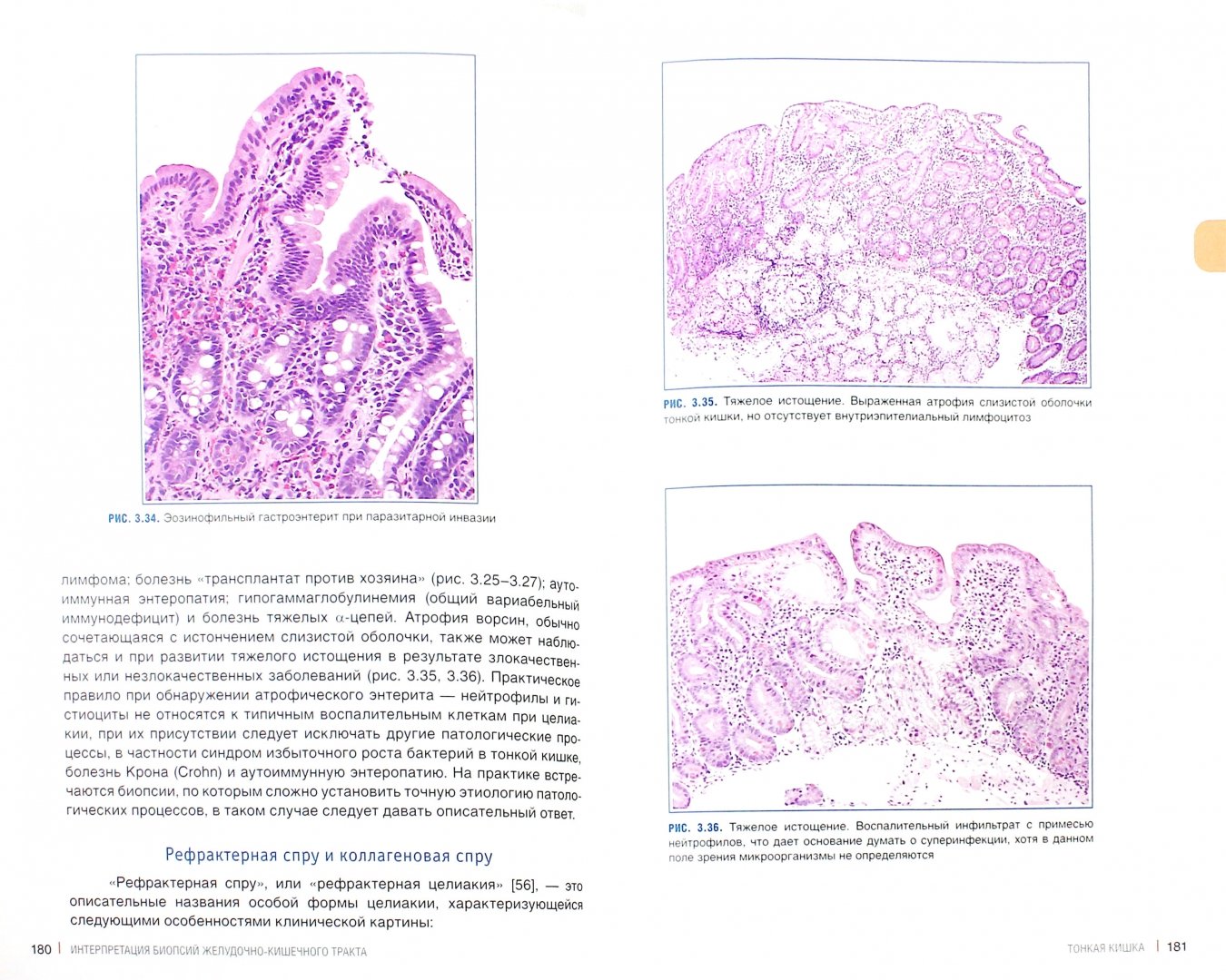 Иллюстрация 9 из 14 для Интерпретация биопсий желудочно-кишечного тракта. Том 1. Неопухолевые болезни - Монтгомери, Вольтаджо | Лабиринт - книги. Источник: Лабиринт