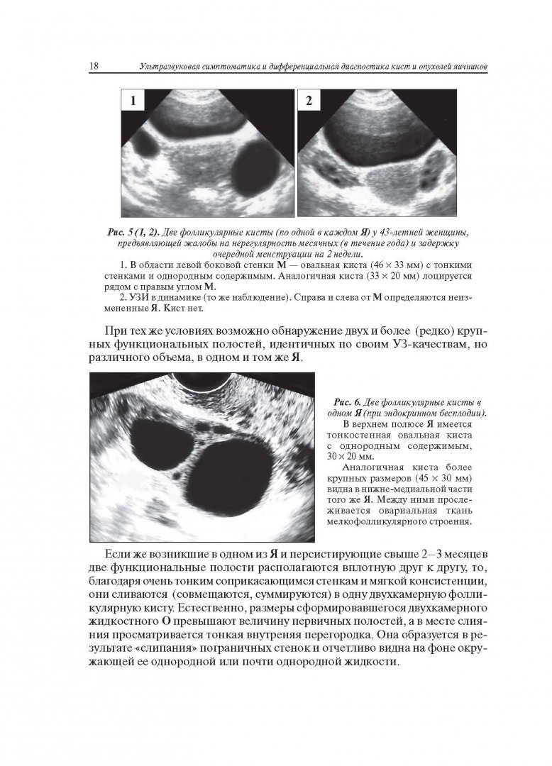 Иллюстрация 7 из 22 для Ультразвуковая симптоматика и дифференциальная диагностика кист и опухолей яичников - Сурен Хачкурузов | Лабиринт - книги. Источник: Лабиринт