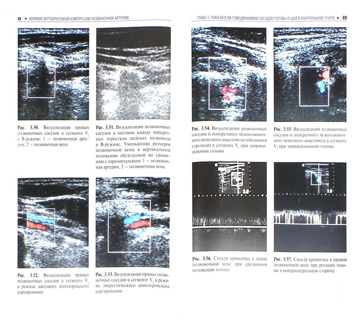 Иллюстрация 1 из 5 для Влияние вертеброгенной компрессии позвоночной артерии на гемодинамические параметры сосудов головы - Калинин, Сучков, Виноградов, Калина | Лабиринт - книги. Источник: Лабиринт