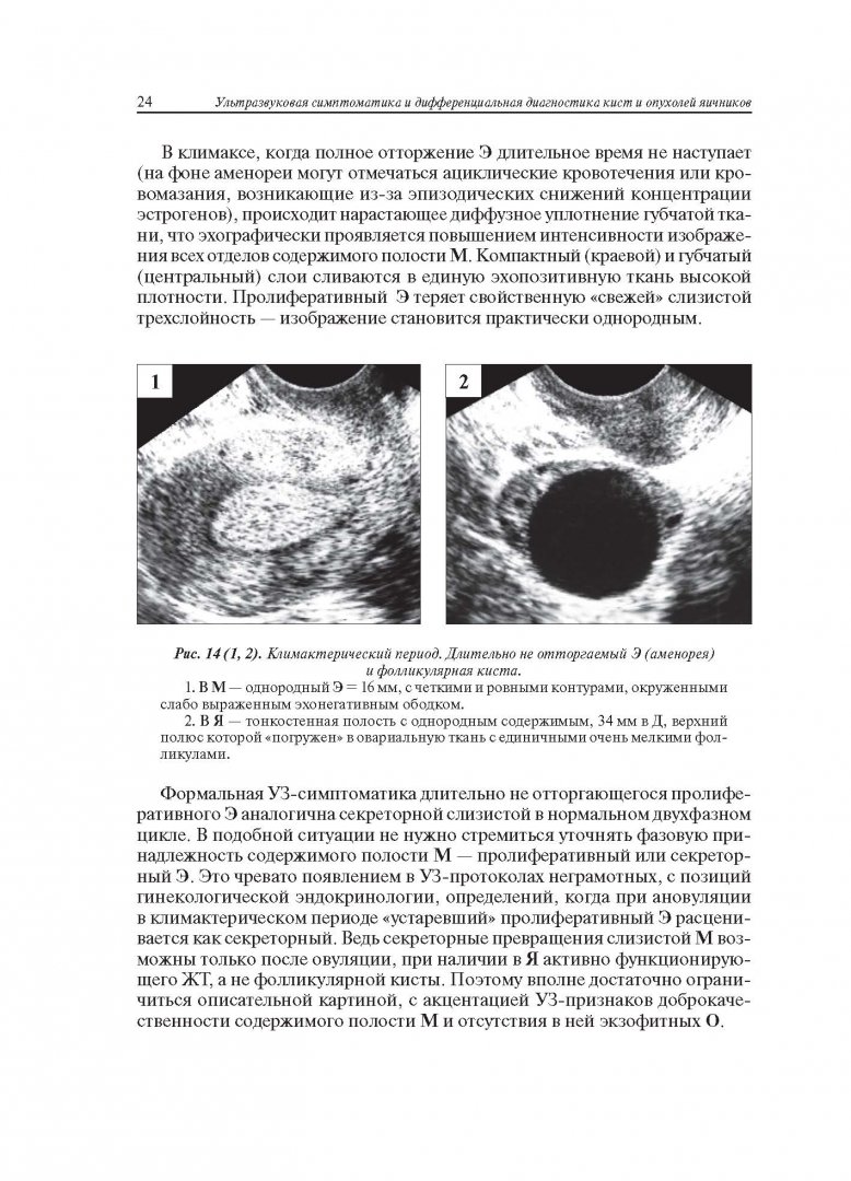 Иллюстрация 13 из 22 для Ультразвуковая симптоматика и дифференциальная диагностика кист и опухолей яичников - Сурен Хачкурузов | Лабиринт - книги. Источник: Лабиринт