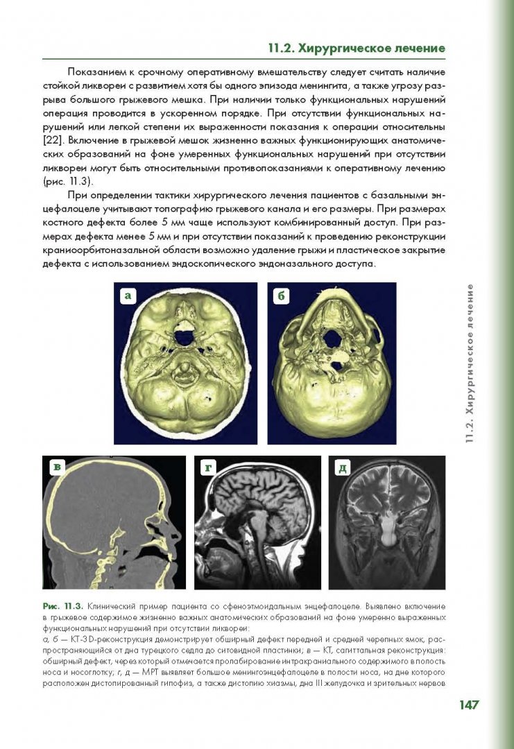 Иллюстрация 15 из 28 для Эндоскопическая диагностика и лечение назальной ликвореи - Потапов, Лопатин, Капитанов | Лабиринт - книги. Источник: Лабиринт